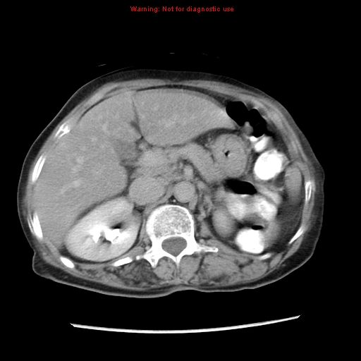 File:Adenocarcinoma of the colon (Radiopaedia 8191-9039 Axial renal excretory phase 11).jpg