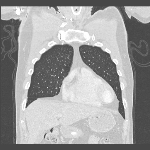 Adenocarcinoma of the lung (Radiopaedia 59871-67325 Coronal lung window 9).jpg