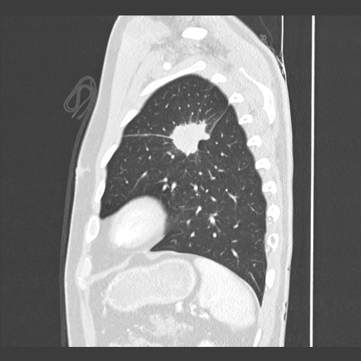 Adenocarcinoma of the lung (Radiopaedia 59871-67325 Sagittal lung window 82).jpg