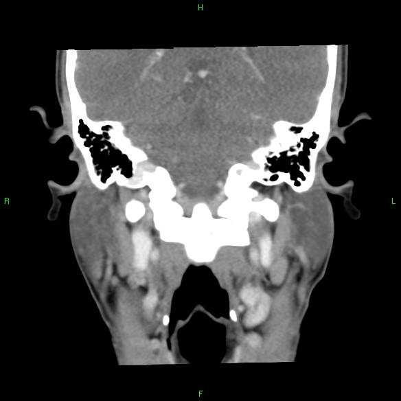 File:Adenoid cystic carcinoma of hard palate (Radiopaedia 26137-26273 Coronal liver window 26).jpg
