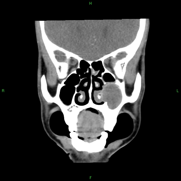 File:Adenoid cystic carcinoma of hard palate (Radiopaedia 26137-26273 Coronal liver window 9).jpg