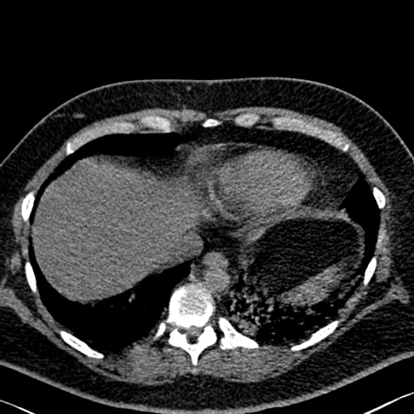 Adenoid cystic carcinoma of the trachea (Radiopaedia 49042-54137 Axial non-contrast 278).jpg