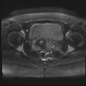 File:Adenomyosis and endometriotic cysts (Radiopaedia 82300-96367 Axial DWI 25).jpg