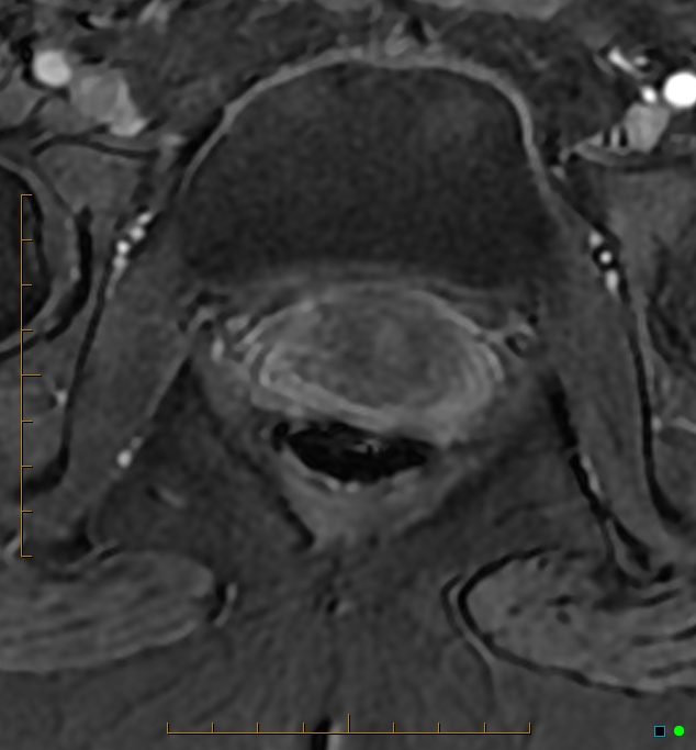 Adenomyosis uterus with hematometra (Radiopaedia 45779-50011 Axial T1 C+ fat sat 58).jpg