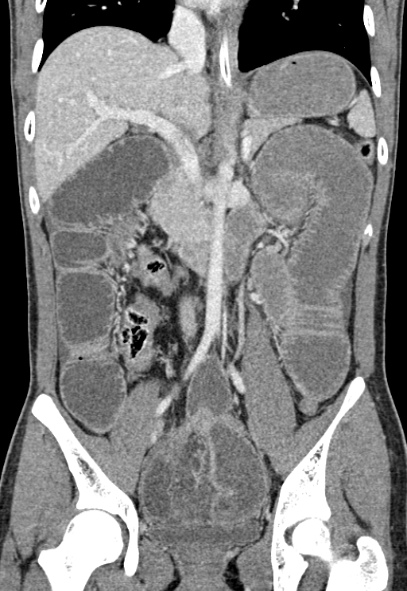 Adhesional small bowel obstruction (Radiopaedia 52107-57980 Coronal C+ portal venous phase 42).jpg