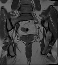 File:Adnexal multilocular cyst (O-RADS US 3- O-RADS MRI 3) (Radiopaedia 87426-103754 Coronal 22).jpg