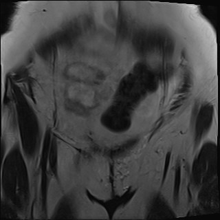 File:Adnexal multilocular cyst (O-RADS US 3- O-RADS MRI 3) (Radiopaedia 87426-103754 Coronal T2 5).jpg