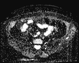 File:Adnexal multilocular cyst (O-RADS US 3. O-RADS MRI 3) (Radiopaedia 87426-103754 Axial 179).jpeg