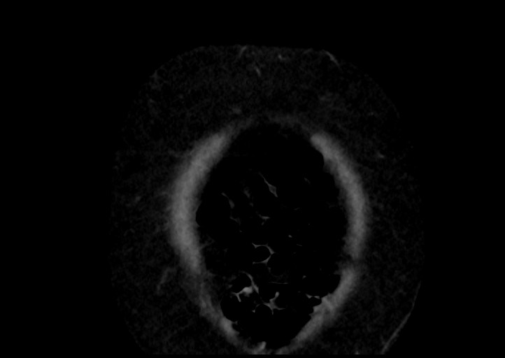 File:Adrenal cortical carcinoma (Radiopaedia 64017-72769 Coronal C+ portal venous phase 2).jpg