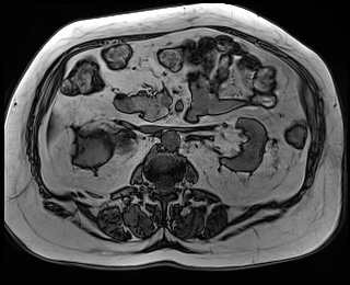 File:Adrenal cortical carcinoma (Radiopaedia 64017-72770 Axial T1 out-of-phase 39).jpg