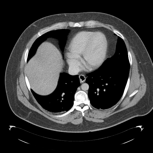 File:Adrenal cyst (Radiopaedia 45625-49776 Axial C+ portal venous phase 9).png