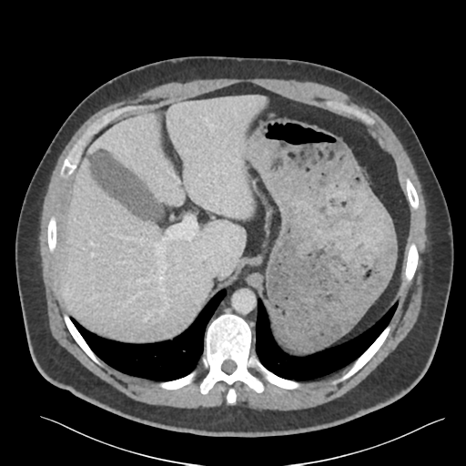 File:Adrenal cyst (Radiopaedia 45625-49777 Axial C+ portal venous phase 26).png