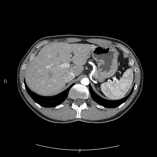 Adrenal cystic lymphangioma (Radiopaedia 83161-97534 Axial C+ arterial phase 24).jpg
