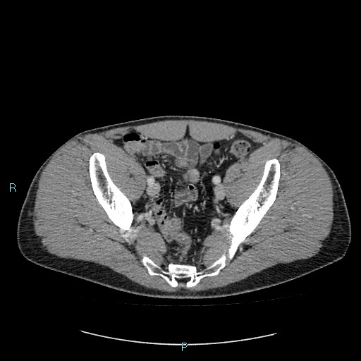 File:Adrenal cystic lymphangioma (Radiopaedia 83161-97534 Axial C+ portal venous phase 82).jpg