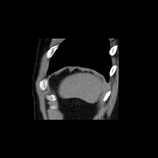 File:Adrenal gland trauma (Radiopaedia 81351-95079 Sagittal non-contrast 93).jpg