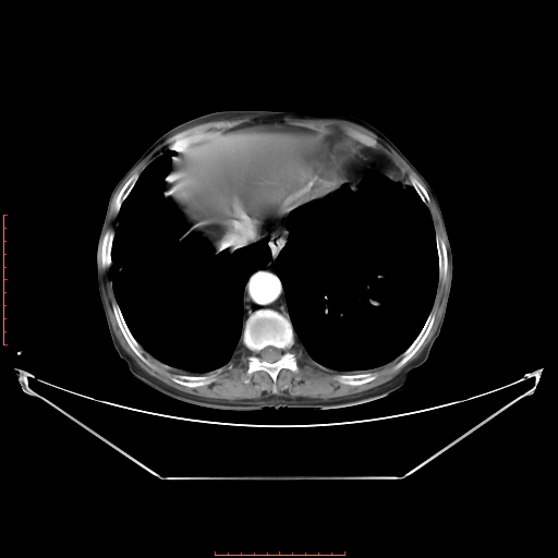Adrenal hemangioma (Radiopaedia 68923-78668 Axial C+ arterial phase 16).jpg