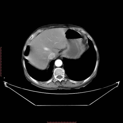 Adrenal hemangioma (Radiopaedia 68923-78668 Axial C+ arterial phase 20).jpg