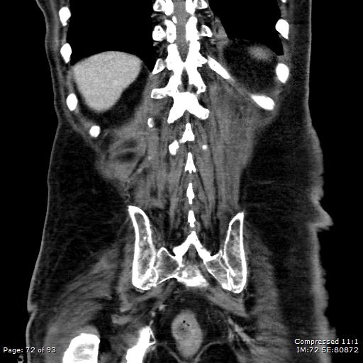 Adrenal metastasis (Radiopaedia 78425-91079 Sagittal C+ portal venous phase 59).jpg
