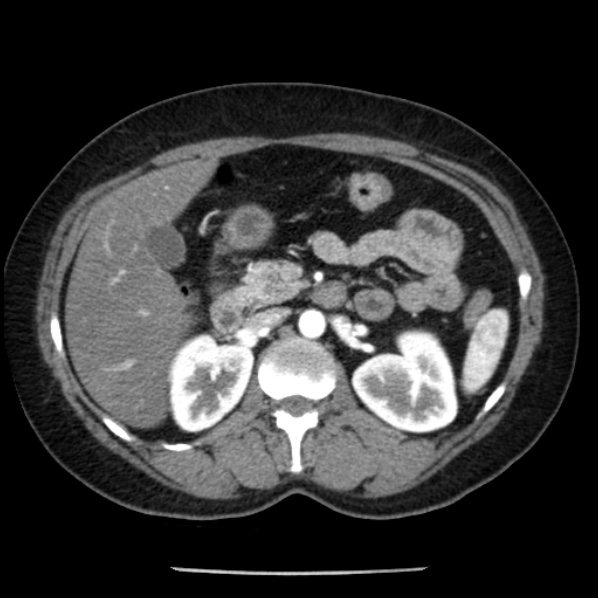 Adrenal myelolipoma (Radiopaedia 43401-46759 Axial C+ arterial phase 38).jpg