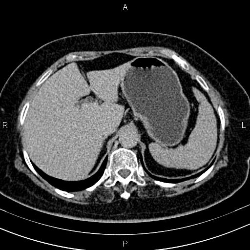 Adrenal myelolipoma (Radiopaedia 82742-96986 Axial renal excretory phase 27).jpg