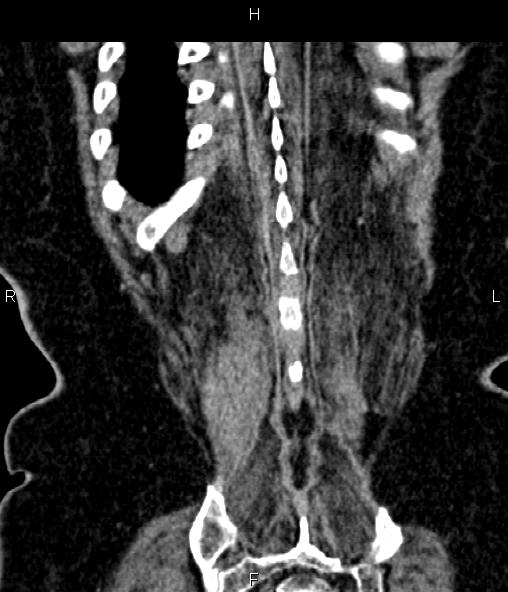 Adrenal myelolipoma (Radiopaedia 82742-96986 Coronal renal cortical phase 69).jpg