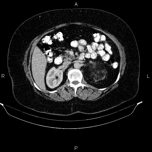 Adrenal myelolipoma (Radiopaedia 84319-99617 Axial renal cortical phase 47).jpg