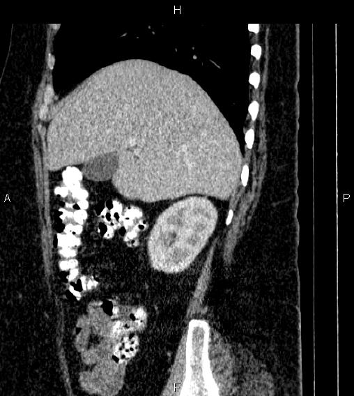 File:Adrenal myelolipoma (Radiopaedia 84319-99617 Sagittal renal cortical phase 24).jpg