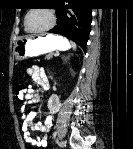 Adrenal myelolipoma (Radiopaedia 84319-99617 Sagittal renal cortical phase 63).jpg
