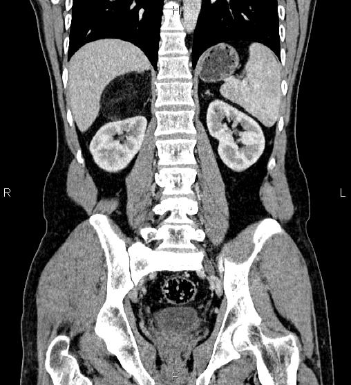 Adrenal myelolipoma (Radiopaedia 87794-104246 Coronal renal cortical phase 44).jpg