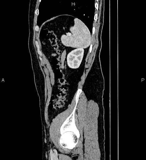 Adrenal myelolipoma (Radiopaedia 87794-104246 Sagittal renal cortical phase 79).jpg