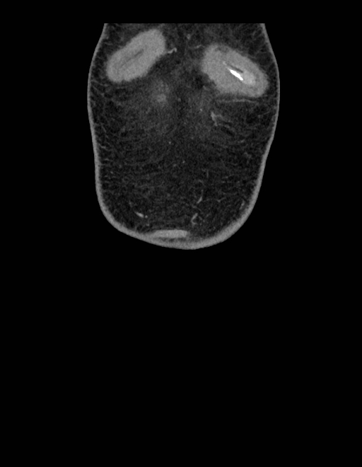 Adrenal myelolipoma - bilateral (Radiopaedia 74805-85810 Coronal C+ portal venous phase 259).jpg