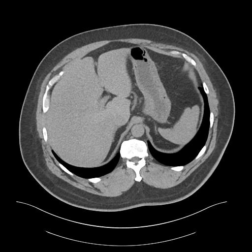 File:Adrenal vein sampling and adrenal nodular hyperplasia - Conn syndrome (Radiopaedia 30561-31337 Axial non-contrast 14).jpg