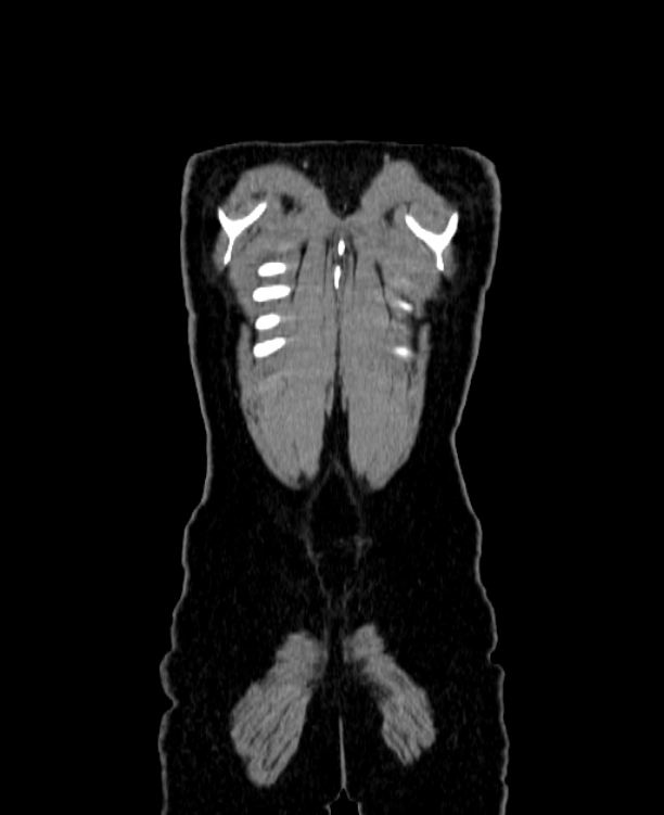 Adrenocortical carcinoma (Radiopaedia 80134-93438 Coronal C+ portal venous phase 160).jpg