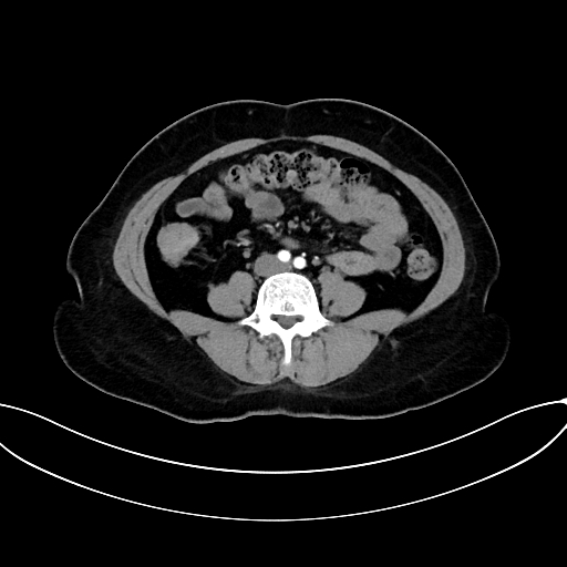 Adrenocortical carcinoma (Radiopaedia 87281-103569 Axial C+ arterial phase 53).jpg