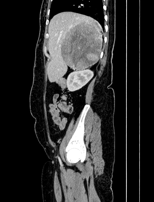 Adrenocortical carcinoma (Radiopaedia 87281-103569 Sagittal C+ portal venous phase 62).jpg