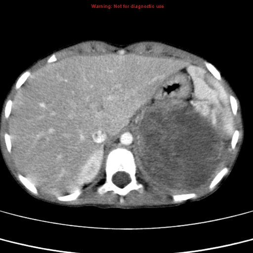 File:Adrenocortical carcinoma (Radiopaedia 9449-10131 Axial C+ portal venous phase 11).jpg