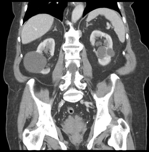Adult ileal intussusception with secondary obstruction (Radiopaedia 30395-31051 Coronal C+ portal venous phase 42).jpg