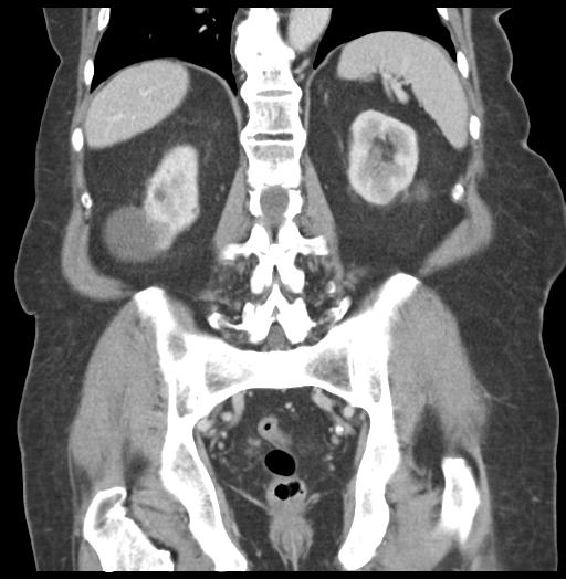 Adult ileal intussusception with secondary obstruction (Radiopaedia 30395-31051 Coronal C+ portal venous phase 45).jpg