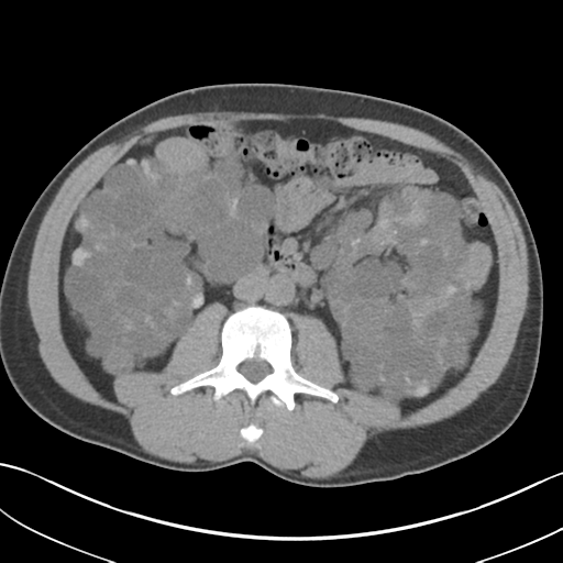 File:Adult polycystic kidney disease (Radiopaedia 47866-52626 Axial non-contrast 39).png