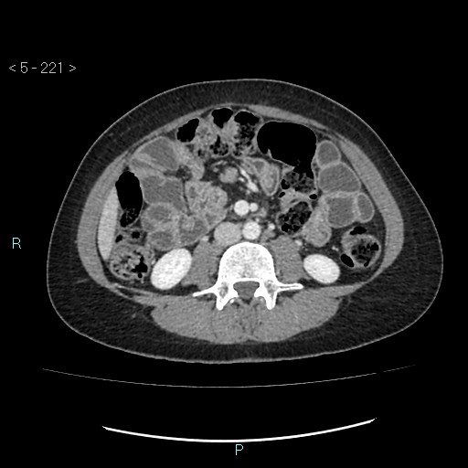 Adult transient intestinal intussusception (Radiopaedia 34853-36310 Axial C+ portal venous phase 43).jpg