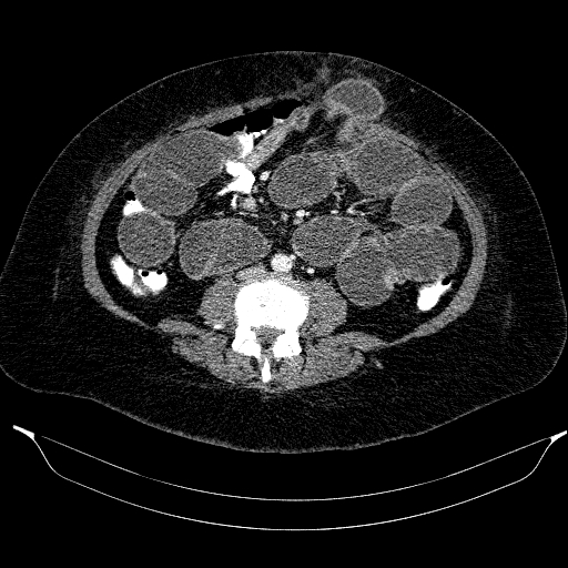 Afferent loop syndrome - secondary to incarcerated trocar site hernia (Radiopaedia 82959-97305 Axial C+ portal venous phase 140).jpg