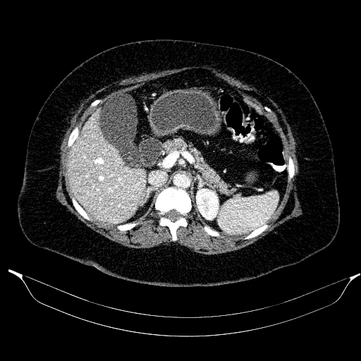 Afferent loop syndrome - secondary to incarcerated trocar site hernia (Radiopaedia 82959-97305 Axial C+ portal venous phase 74).jpg