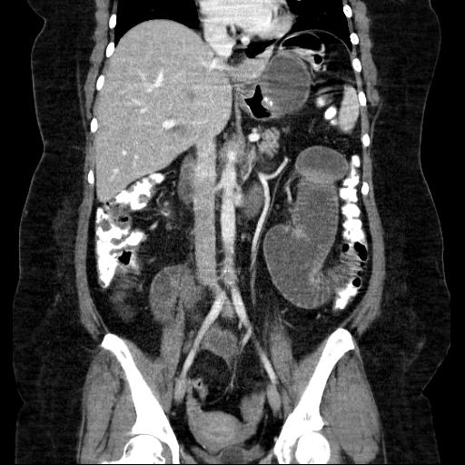 File:Afferent loop syndrome - secondary to incarcerated trocar site hernia (Radiopaedia 82959-97305 Coronal C+ portal venous phase 85).jpg