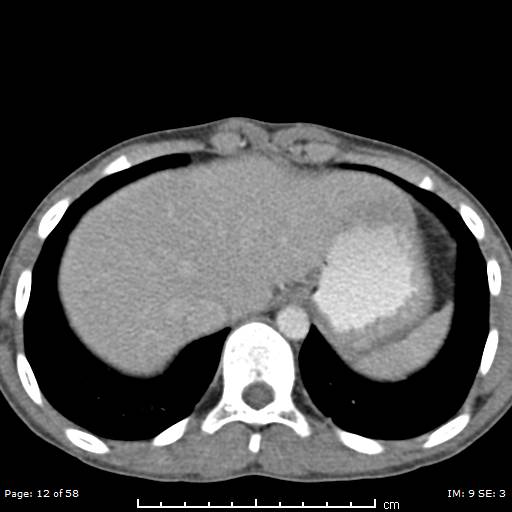 File:Agenesis of the gallbladder (Radiopaedia 55454-61905 B 12).jpg