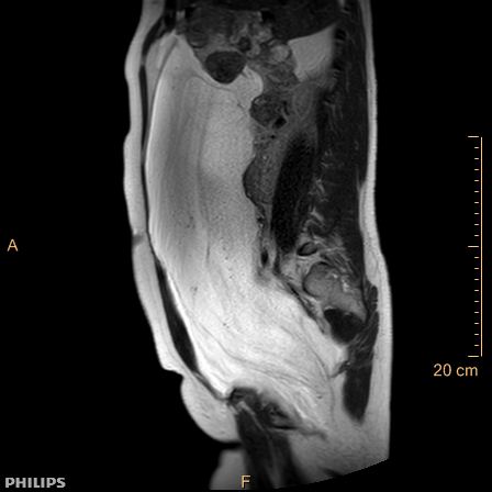 Aggressive angiomyxoma (Radiopaedia 73343-84093 Sagittal T2 24).jpg