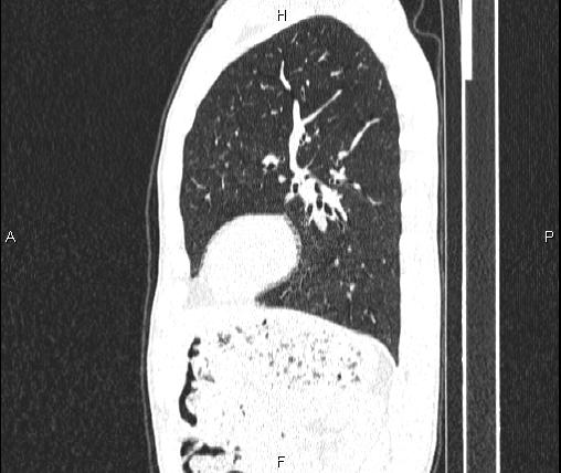 Air bronchogram in pneumonia (Radiopaedia 85719-101512 Sagittal lung window 70).jpg