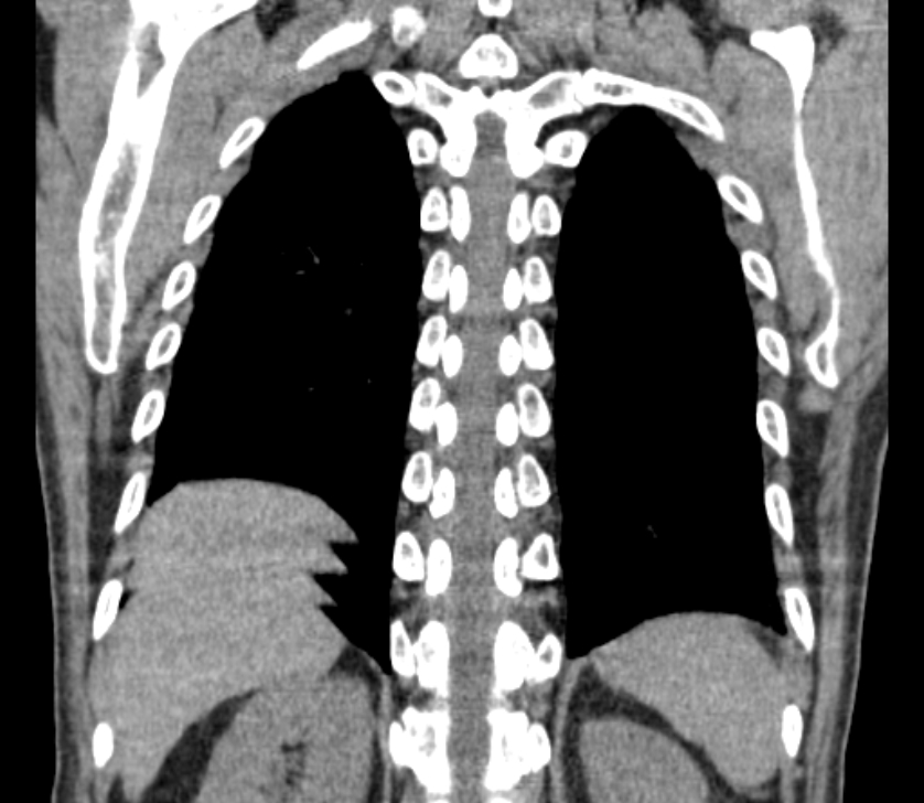 Airway foreign body in adult (Radiopaedia 85907-101779 Coronal liver window 223).jpg