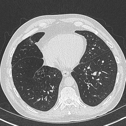 Allergic bronchopulmonary aspergillosis (Radiopaedia 44760-48571 Axial lung window 48).png