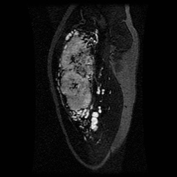Alveolar soft part sarcoma (Radiopaedia 64501-73678 D 102).jpg