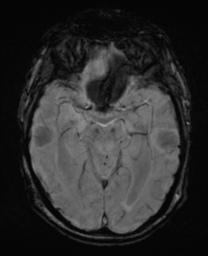 File:Alzheimer's disease- with Gerstmann syndrome and dressing apraxia (Radiopaedia 54882-61150 Axial SWI 14).png